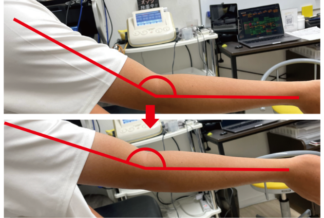 腕の角度改善